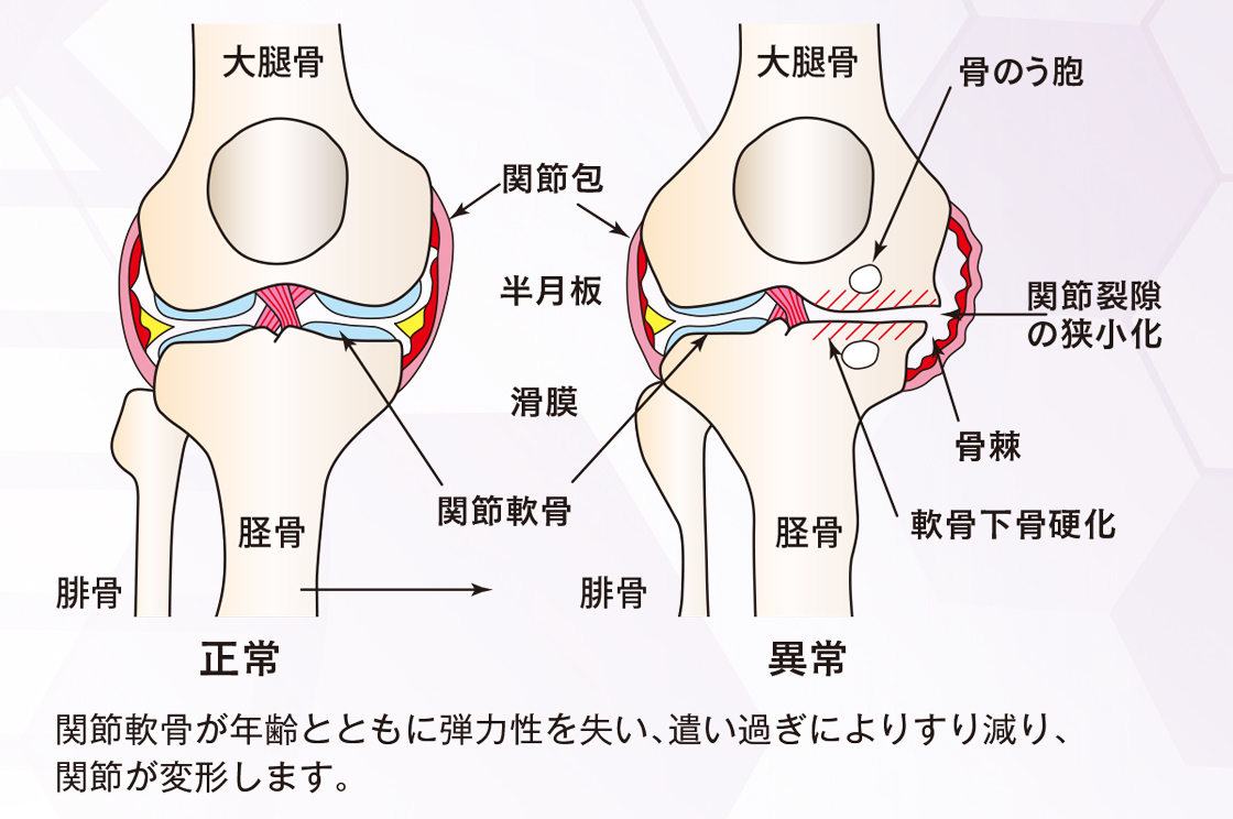 変形性膝関節症 Defomable　knee joint